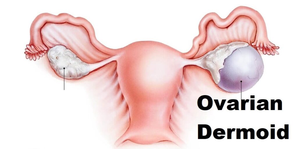 Dermoid cyst ovary