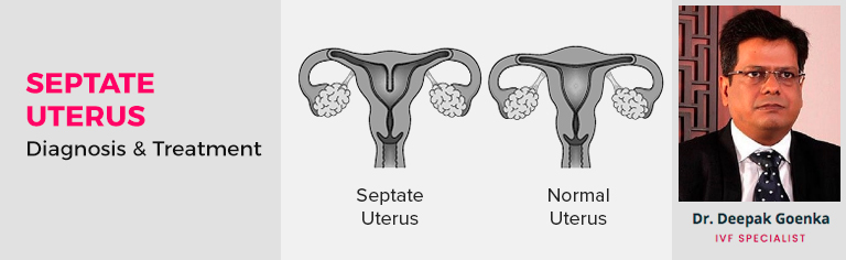 Septate Uterus – Diagnosis & Treatment