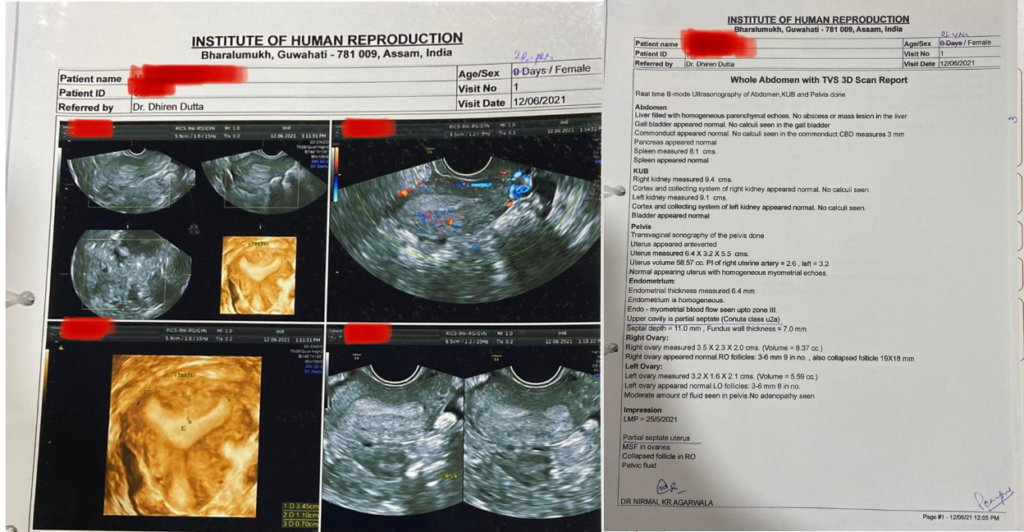 Sub Septate Uterus Diagnosis