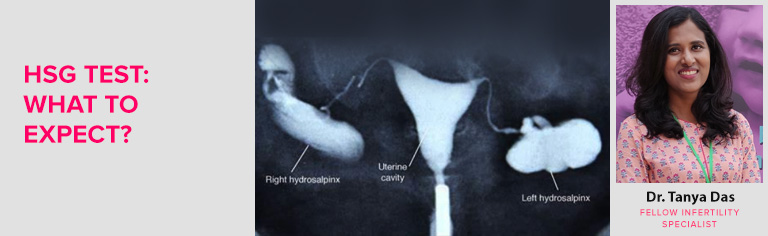 Hysterosalpingogram (HSG Test) Procedure: What to expect?