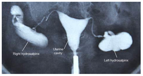 HSG Test showing hydrosalpinx