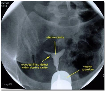 HSG Test showing endometrial polyp