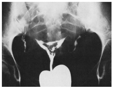 HSG Test showing uterine synechiae