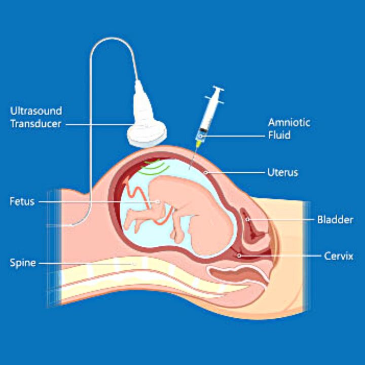 Procedure of the amniocentesis test