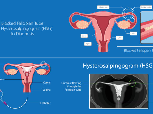 Everything you need to know about the HSG test