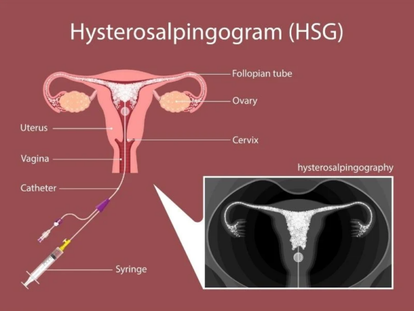 HSG Test: Why It’s Important for Fertility Diagnosis